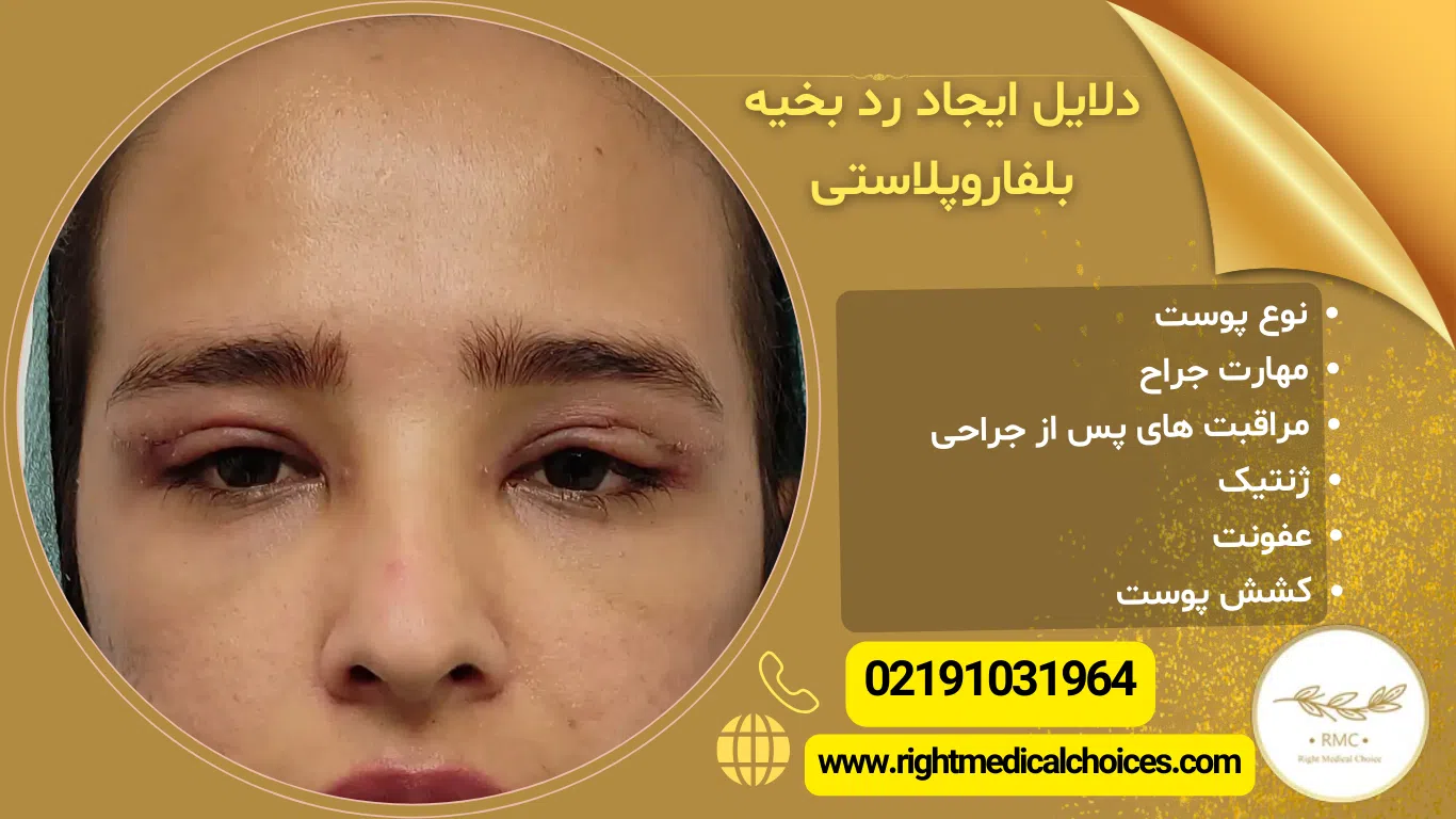 رد بخیه بعد از بلفاروپلاستی