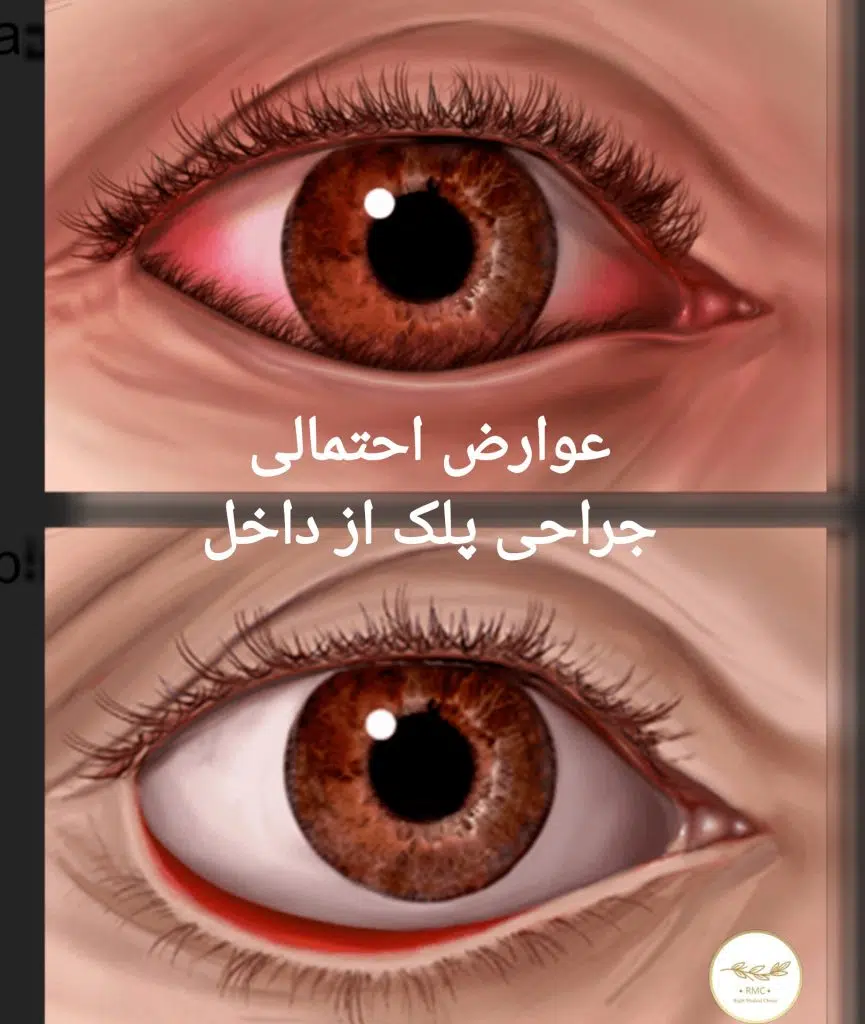 عوارض احتمالی جراحی پلک از داخل