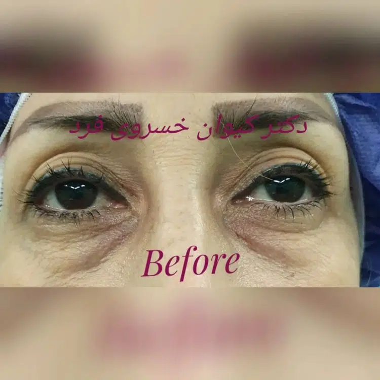 عکس قبل و بعد از عمل پلک | دکتر کیوان خسروی فرد