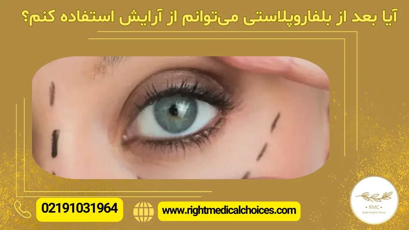 آرایش بعد از بلفاروپلاستی