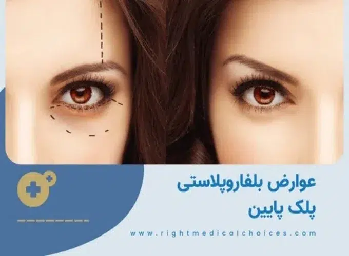 عوارض طبیعی عمل بلفاروپلاستی پلک پایین با لیزر