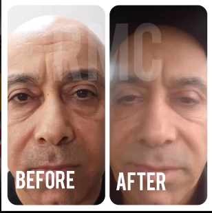 جراحی پلک پایین
