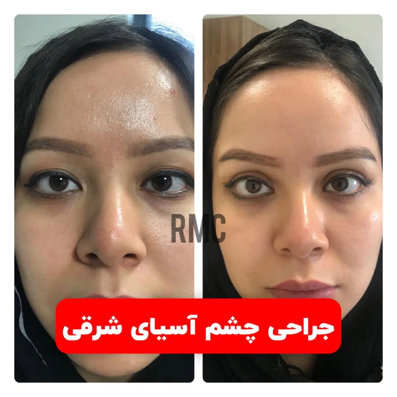 جراحی اپی کانتوپلاستی در بهترین مرکز جشم آسیای شرقی