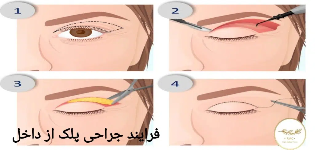 فرآیند جراحی پلک از داخل