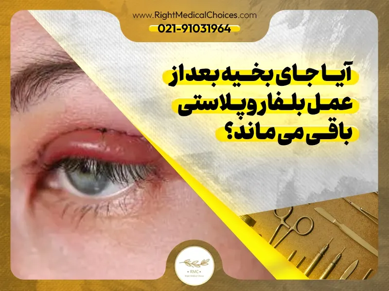 آیا جای بخیه بعد از عمل بلفاروپلاستی باقی می ماند؟