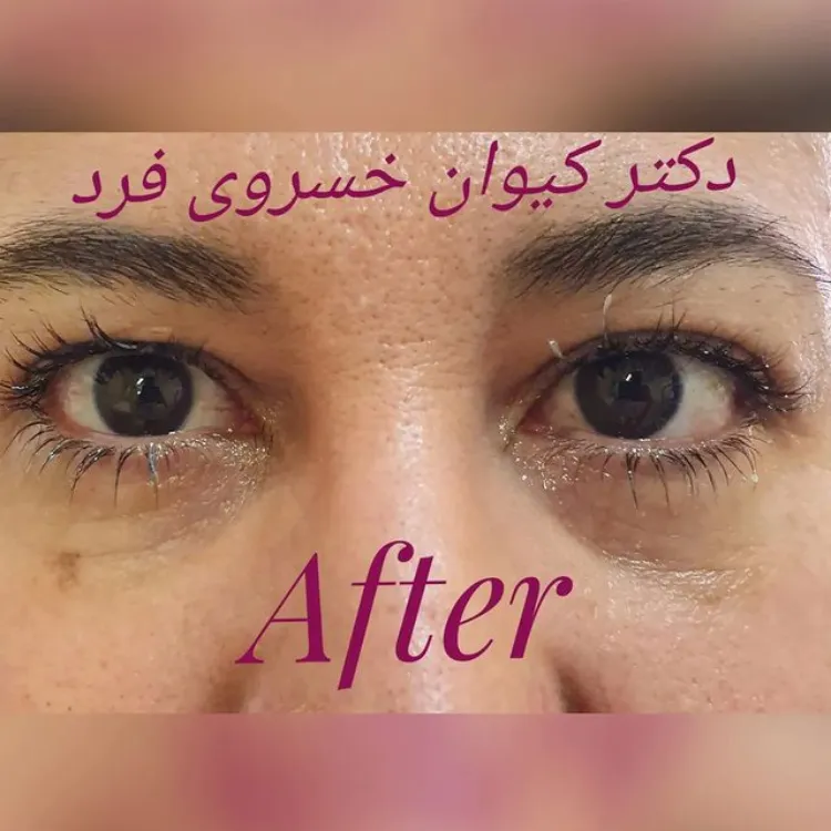 عکس قبل و بعد از جراحی پلک | دکتر کیوان خسروی