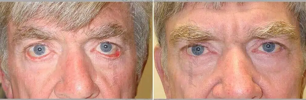 eyelid-malposition-surgery-1-e1728457201556