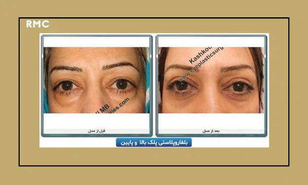 نمونه کارهای جراحی پلک (بلفاروپلاستی) دکتر کشکولی