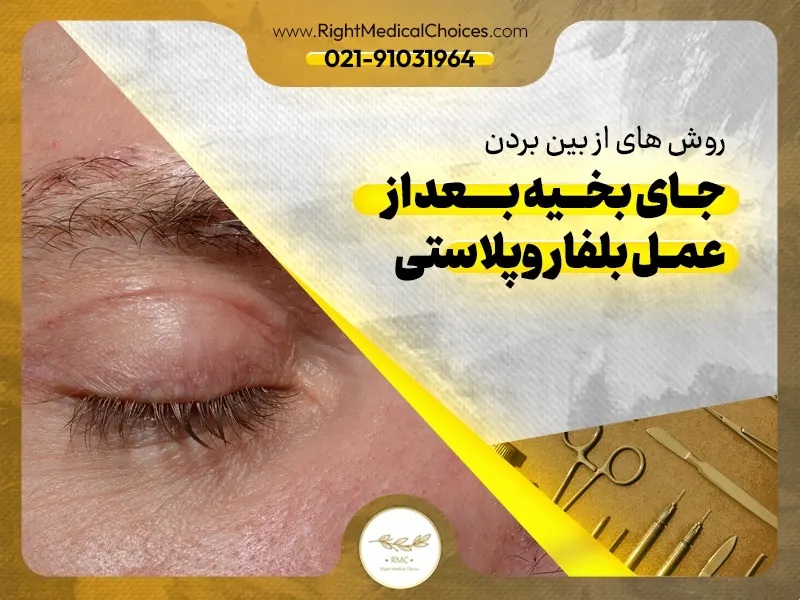 روش های از بین بردن جای بخیه بعد از عمل بلفاروپلاستی