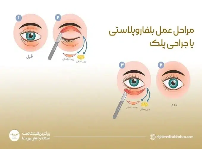 آیا عمل پلک با جراحان غیرمتخصص عوارض دارد؟