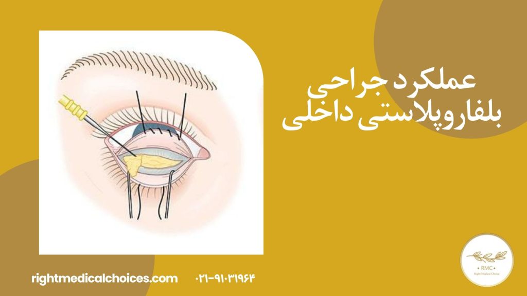 عملکرد جراحی بلفاروپلاستی داخلی