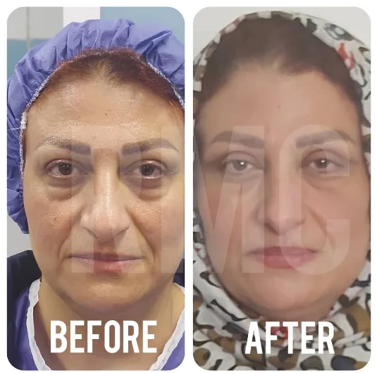 جراحی پلک پایین
