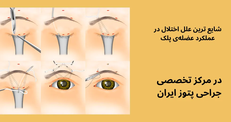 شایع ترین دلیل پتوز پلک چیست؟