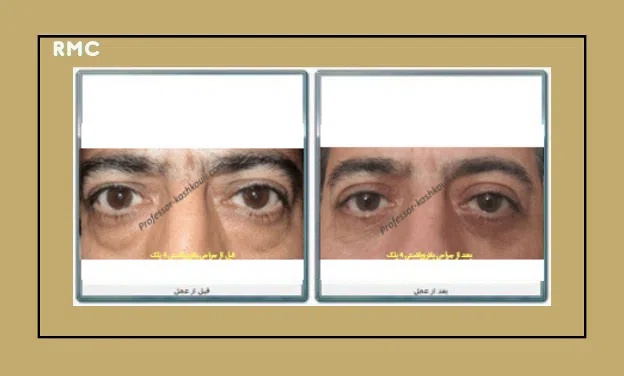 نمونه کارهای جراحی پلک (بلفاروپلاستی) دکتر کشکولی
