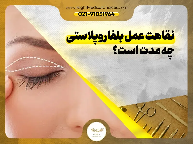 نقاهت عمل بلفاروپلاستی چه مدت است؟