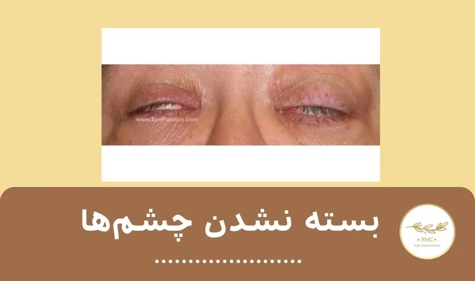 بسته نشدن چشم‌ها از عوارض جراحی پلک پایین