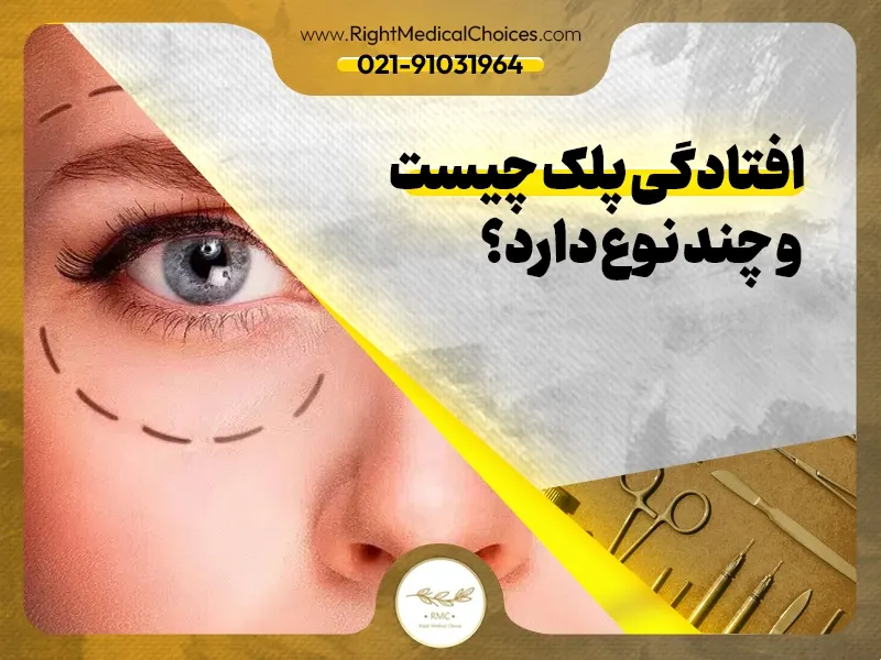 افتادگی پلک چیست و چند نوع دارد؟