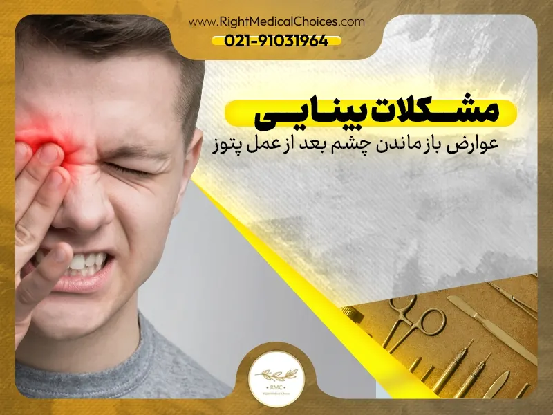 عوارض باز ماندن چشم بعد از عمل پتوز