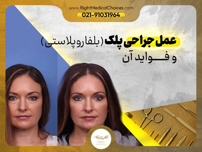 عمل جراحی پلک (بلفاروپلاستی) و فواید آن