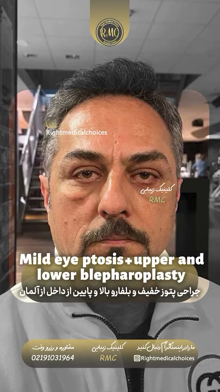 تصویر پیش‌نمایش ویدئوی جراحی پتوز و افتادگی پلک در RMC — 12