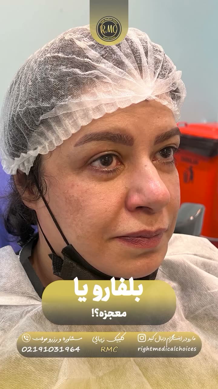 تصویر پیش‌نمایش ویدئوی جراحی پتوز و افتادگی پلک در RMC — 13