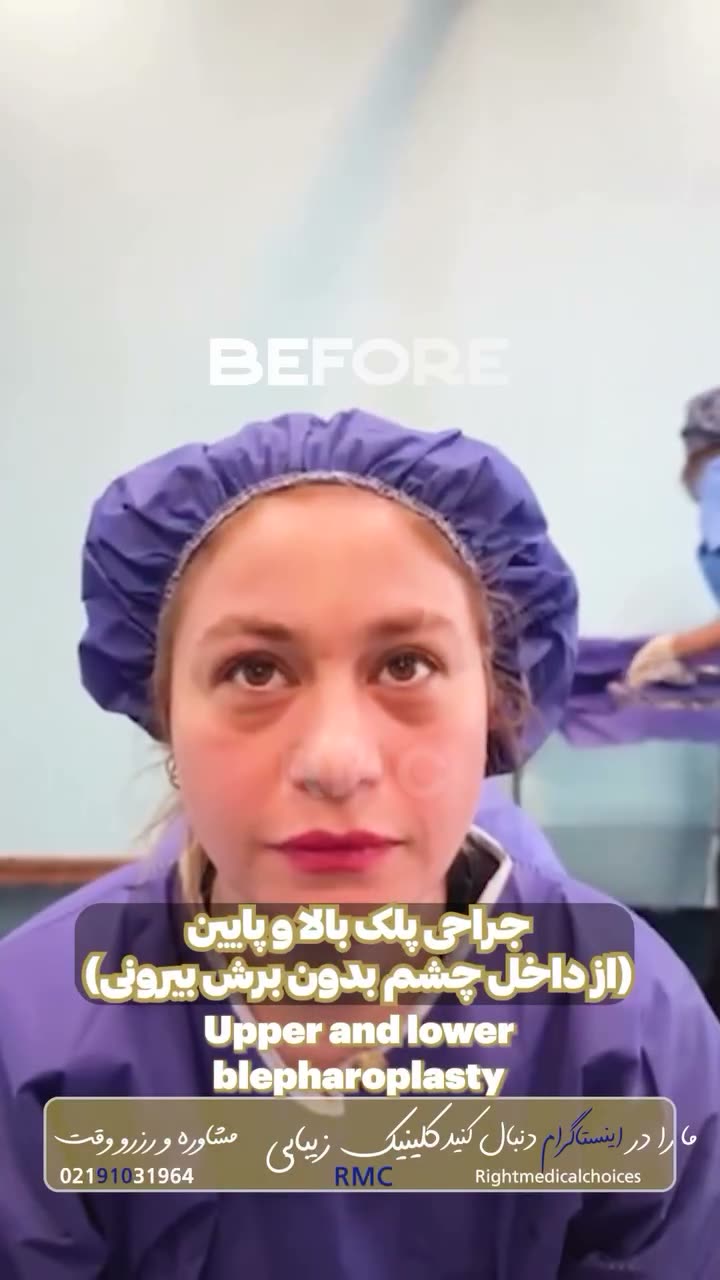 تصویر پیش‌نمایش ویدئوی جراحی پتوز و افتادگی پلک در RMC — 14