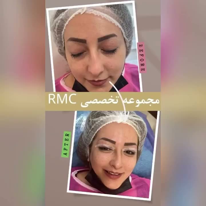 تصویر پیش‌نمایش ویدئوی جراحی پلک بالا در RMC — 3
