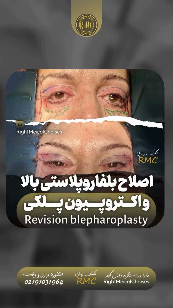 تصویر پیش‌نمایش ویدئوی جراحی پتوز و افتادگی پلک در RMC — 15