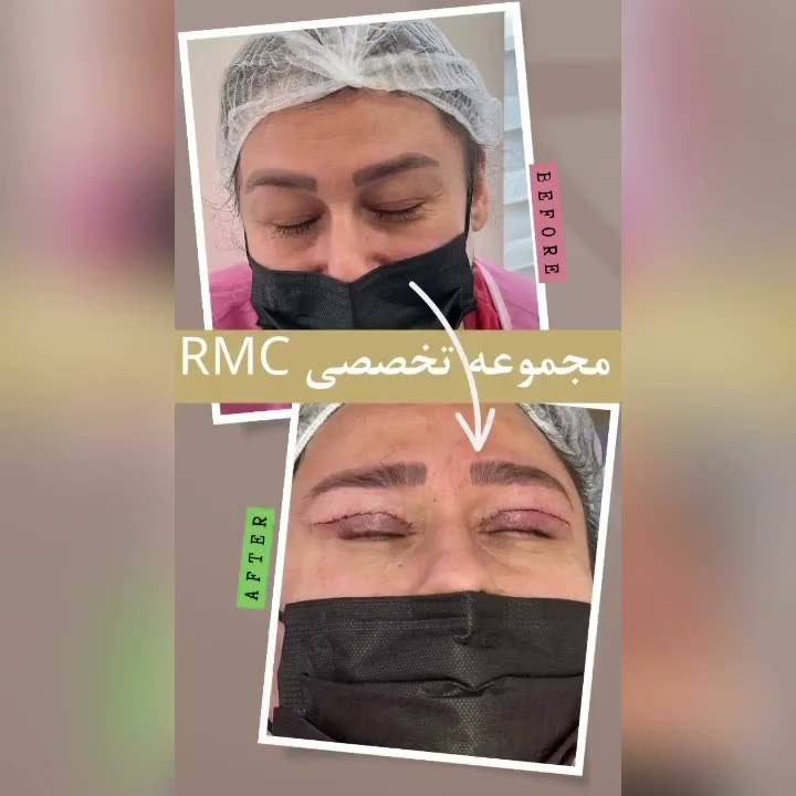 تصویر پیش‌نمایش ویدئوی جراحی پلک بالا در RMC — 4