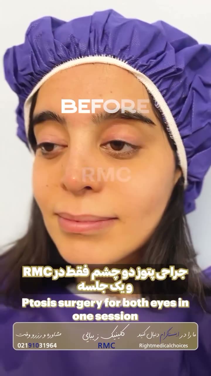 تصویر پیش‌نمایش ویدئوی جراحی پتوز و افتادگی پلک در RMC — 16