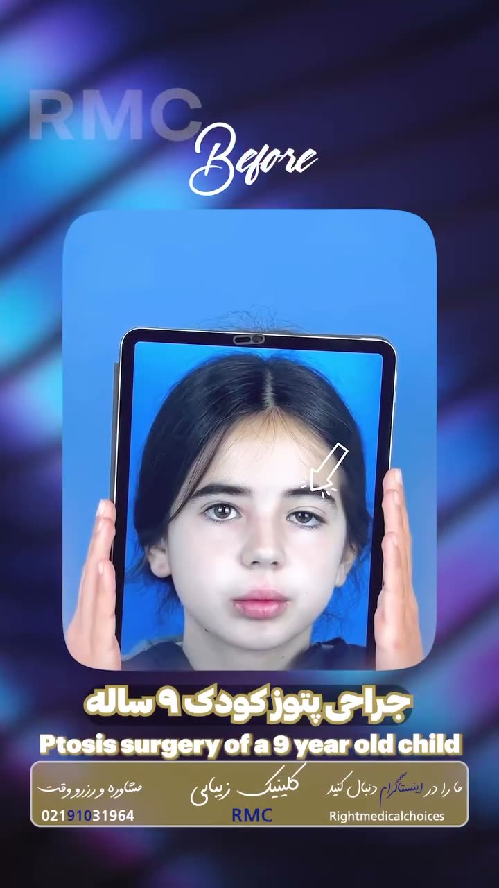 تصویر پیش‌نمایش ویدئوی جراحی پتوز و افتادگی پلک در RMC — 21