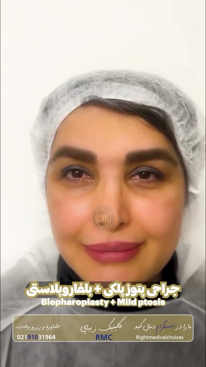تصویر پیش‌نمایش ویدئوی جراحی پتوز و افتادگی پلک در RMC — 18