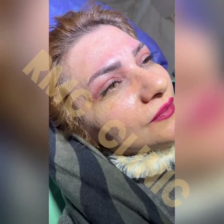 تصویر پیش‌نمایش تجربه دوره بهبود پس از جراحی پلک در RMC — 15