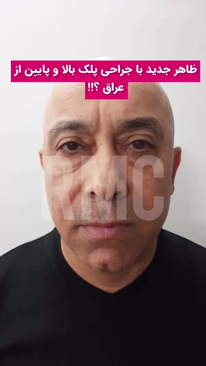 تصویر پیش‌نمایش ویدئوی جراحی پلک بالا در RMC — 8