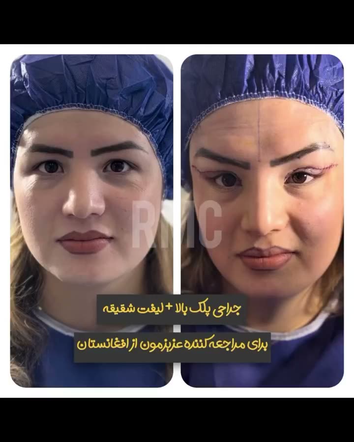 تصویر پیش‌نمایش ویدئوی جراحی پلک بالا در RMC — 9