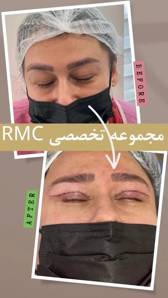 عکس جراحی و بعد عمل بلفاروپلاستی در RMC