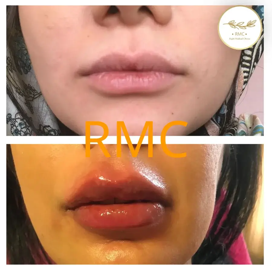 نمونه کار دوره تزریق ژل و بوتاکس در RMC