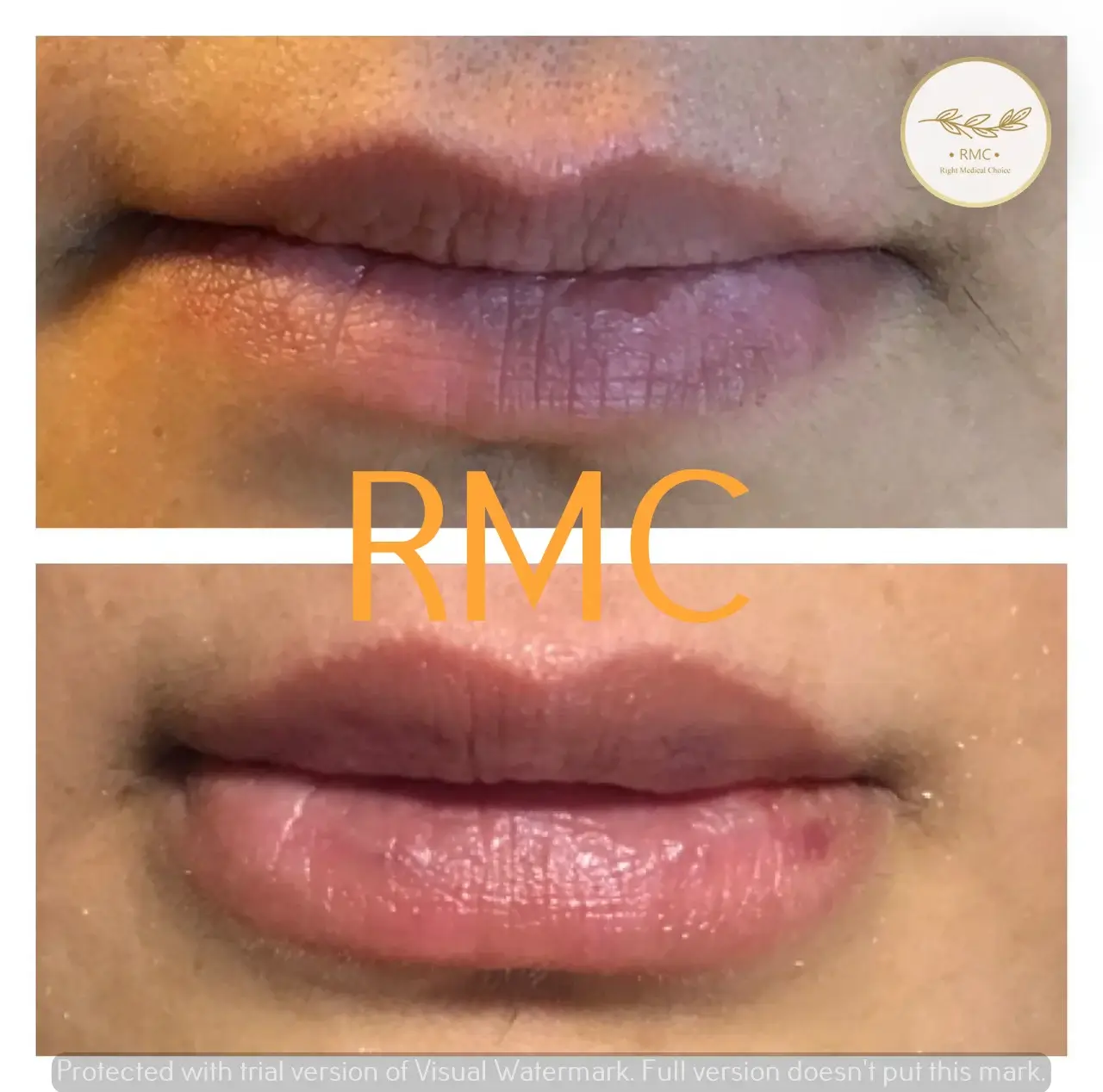 نمونه کار دوره تزریق ژل و بوتاکس در RMC