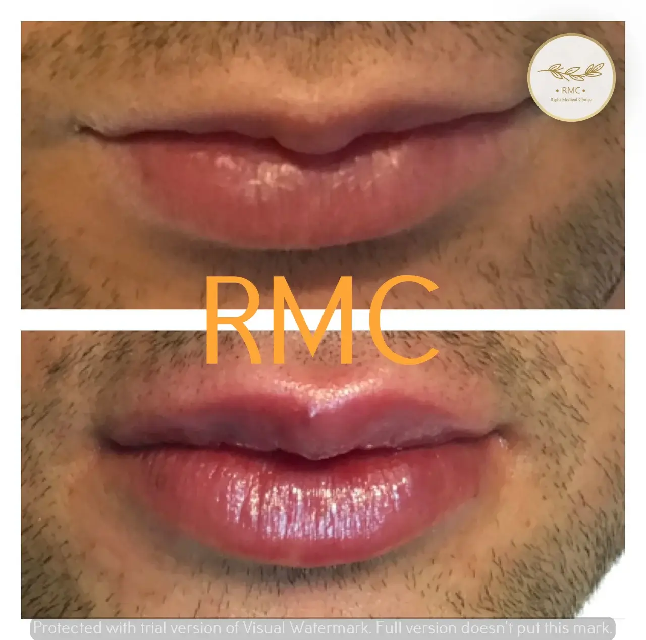 نمونه کار دوره تزریق ژل و بوتاکس در RMC