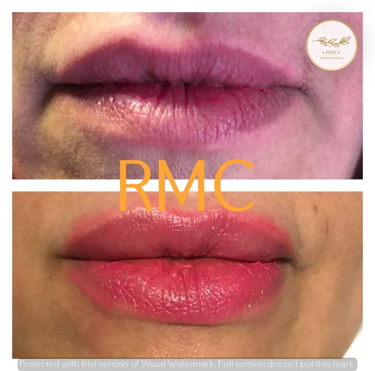 نمونه کار دوره تزریق ژل و بوتاکس در RMC