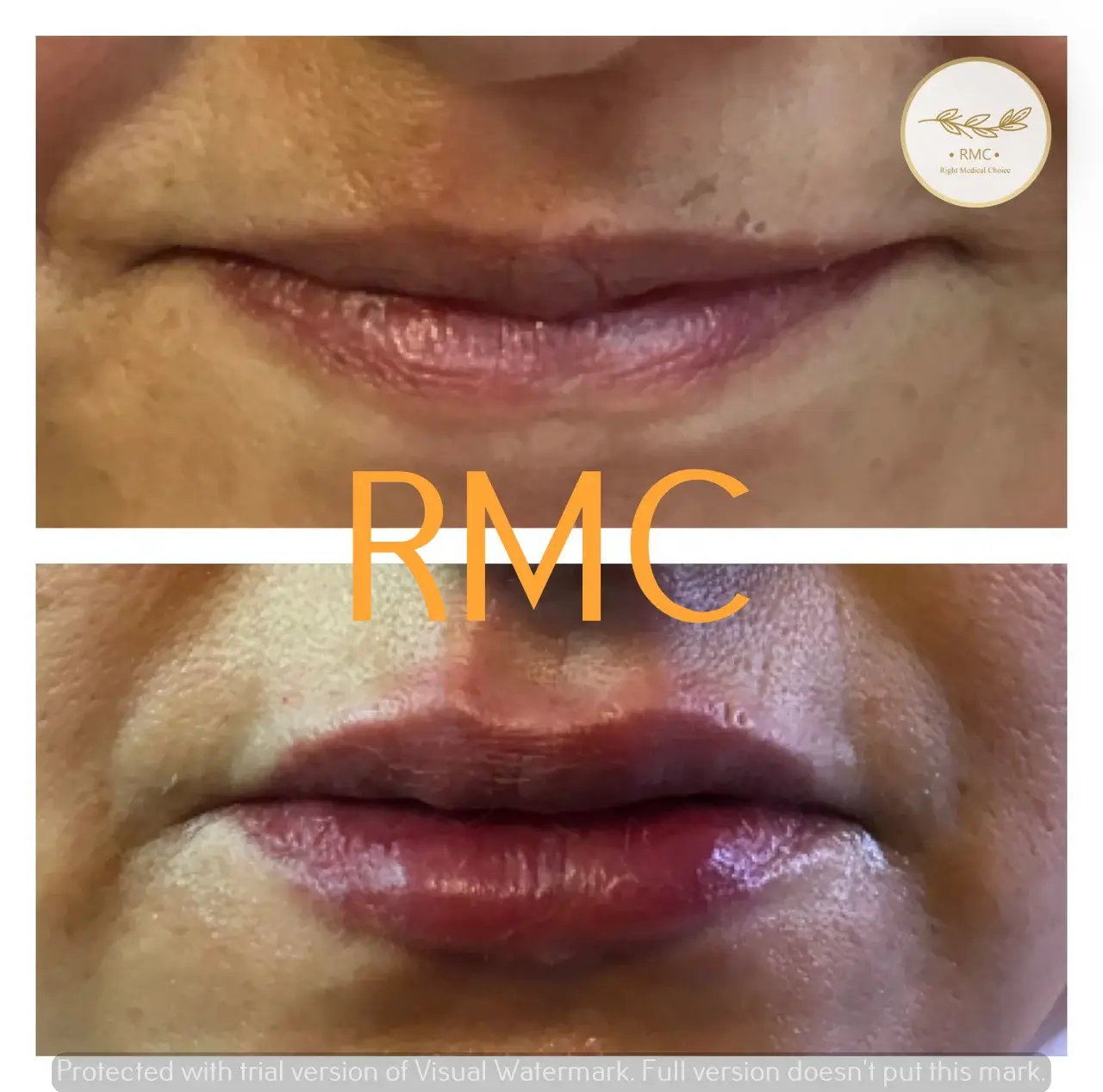 نمونه کار دوره تزریق ژل و بوتاکس در RMC