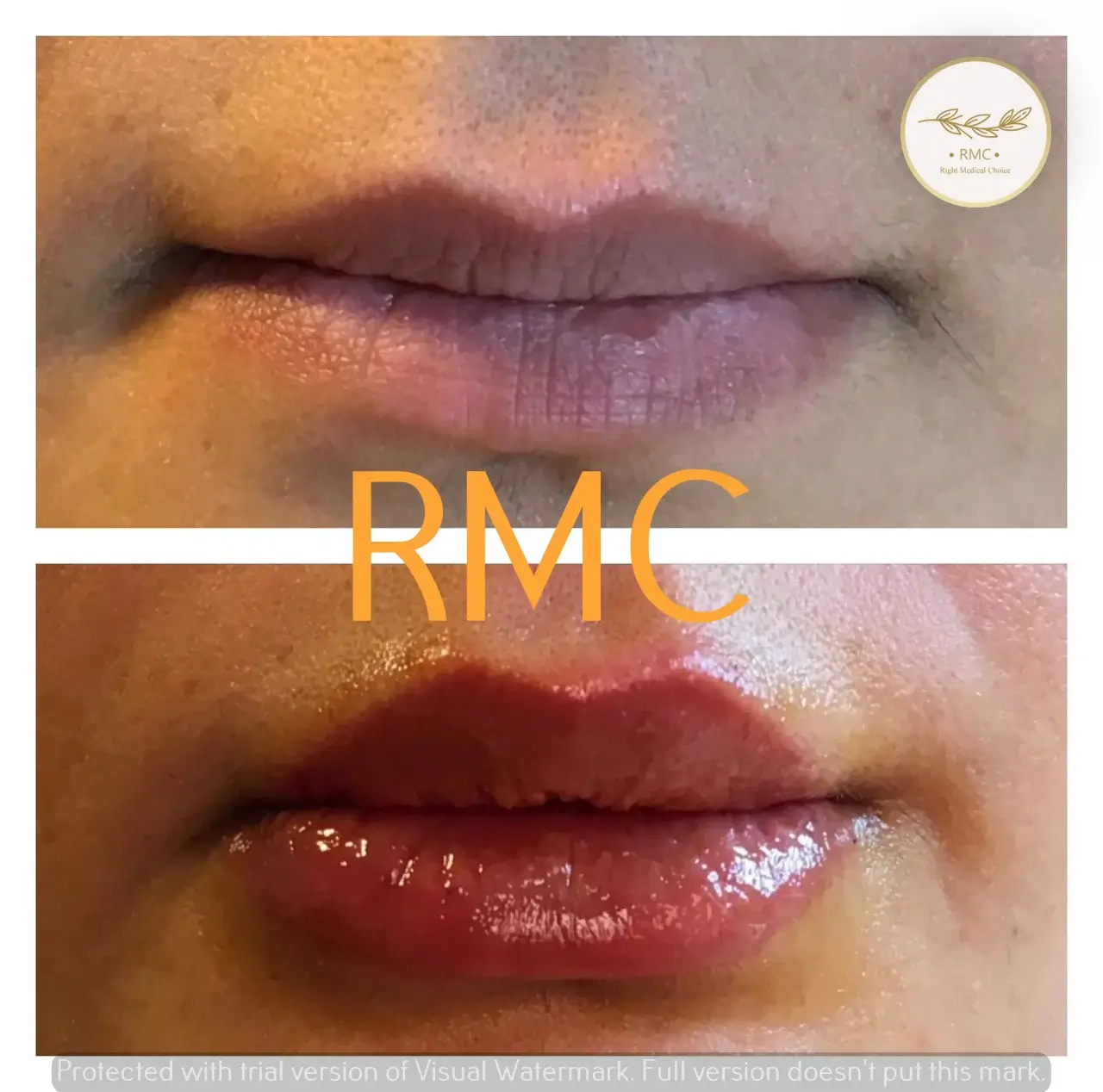 نمونه کار دوره تزریق ژل و بوتاکس در RMC