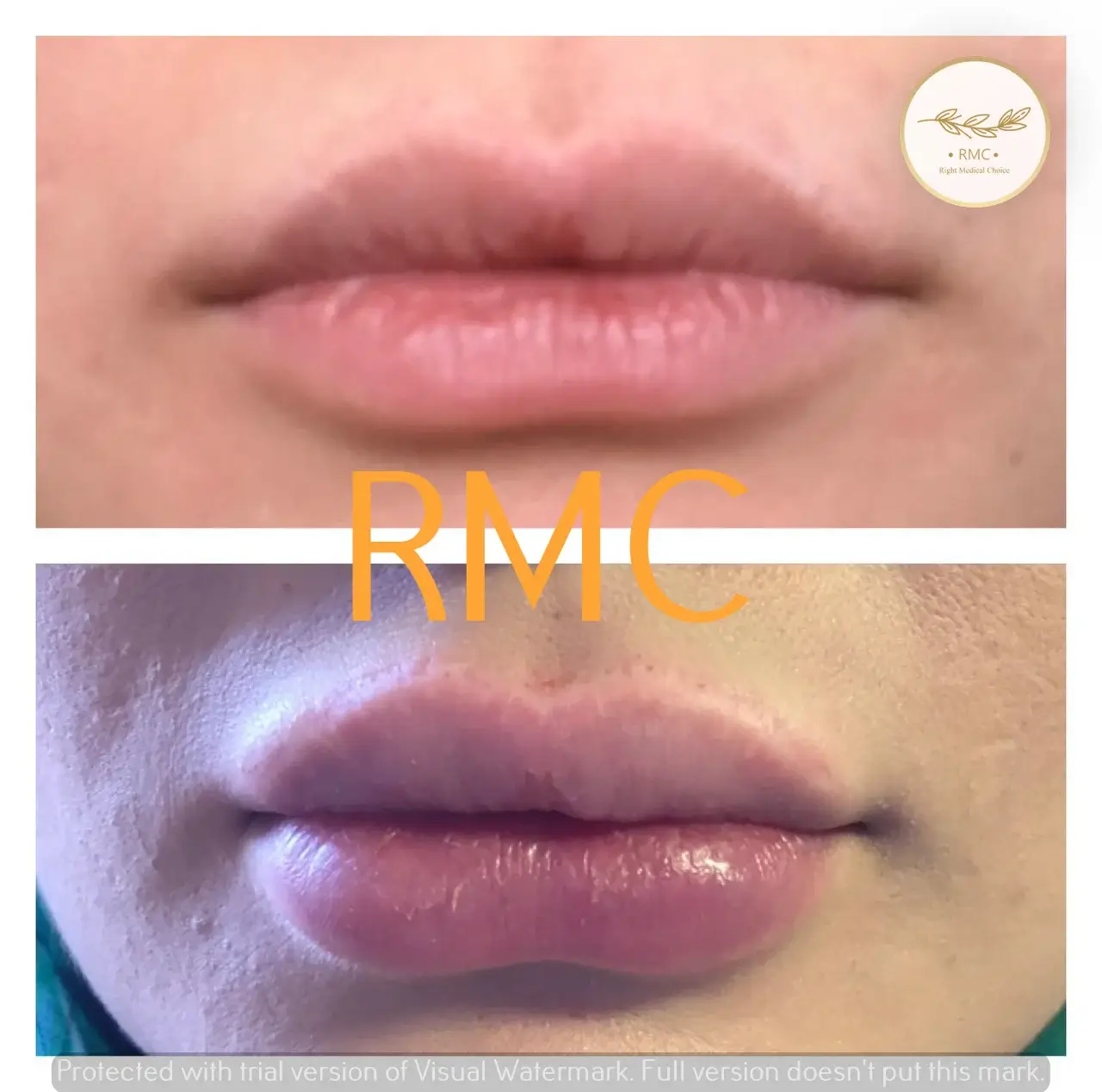 نمونه کار دوره تزریق ژل و بوتاکس در RMC
