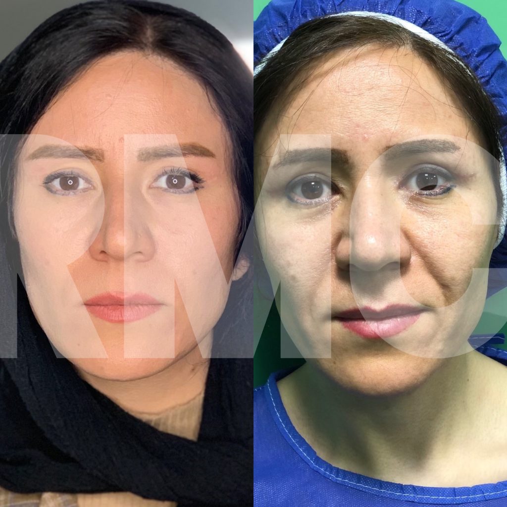 لیفت کامل صورت و جراحی پلک RMC