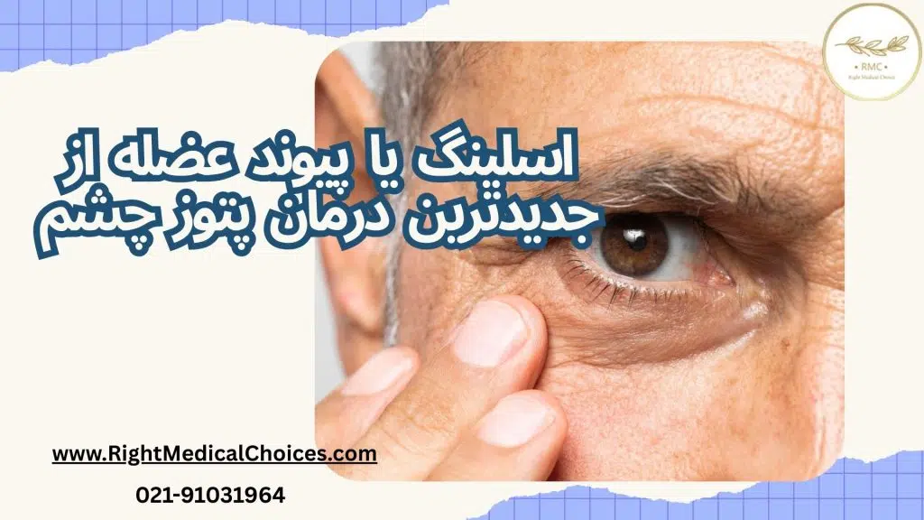 جدیدترین درمان پتوز